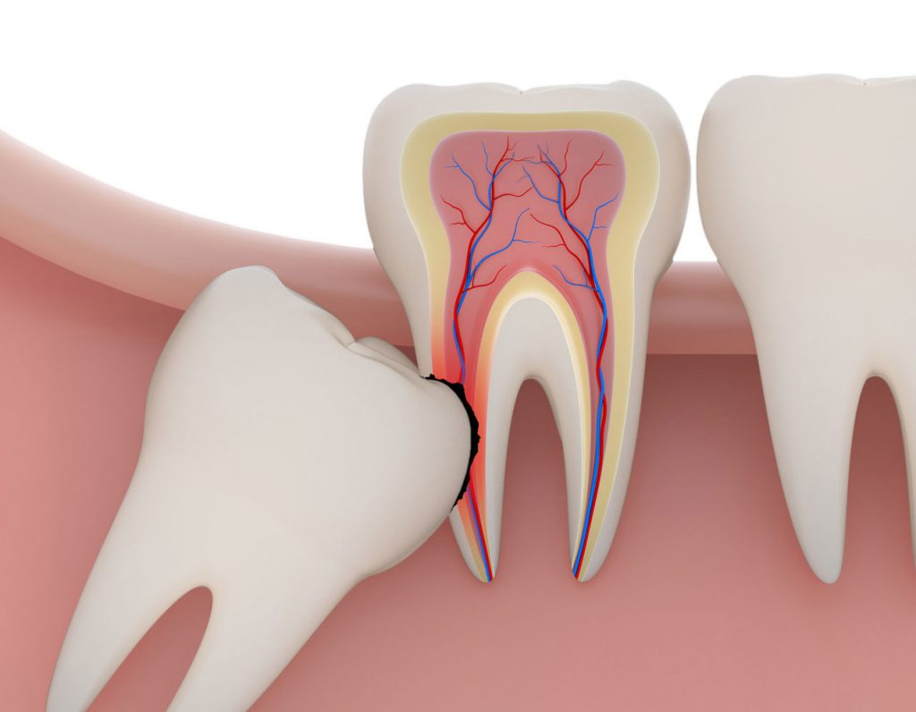 wisdom tooth extraction in Singapore